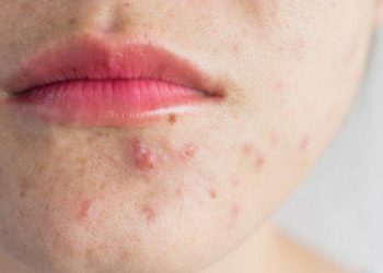 6 Tips Untuk Meredakan Jerawat Dalam Mengatur Polamakan