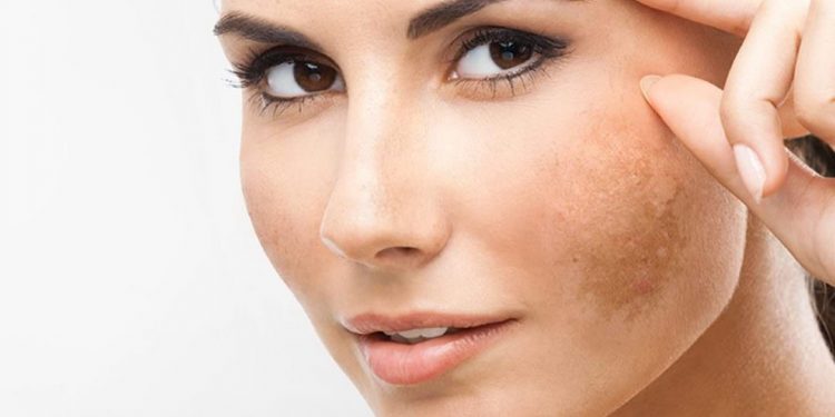 Yuk Intip ! 5 Masker Alami Untuk Hilangkan Flek Hitam Di Wajah